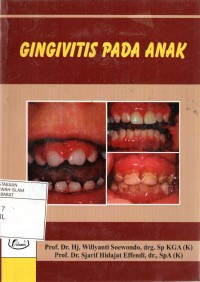 gingivitis pada anak
